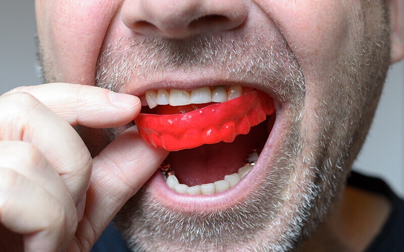 custom mouthguards in south edmonton