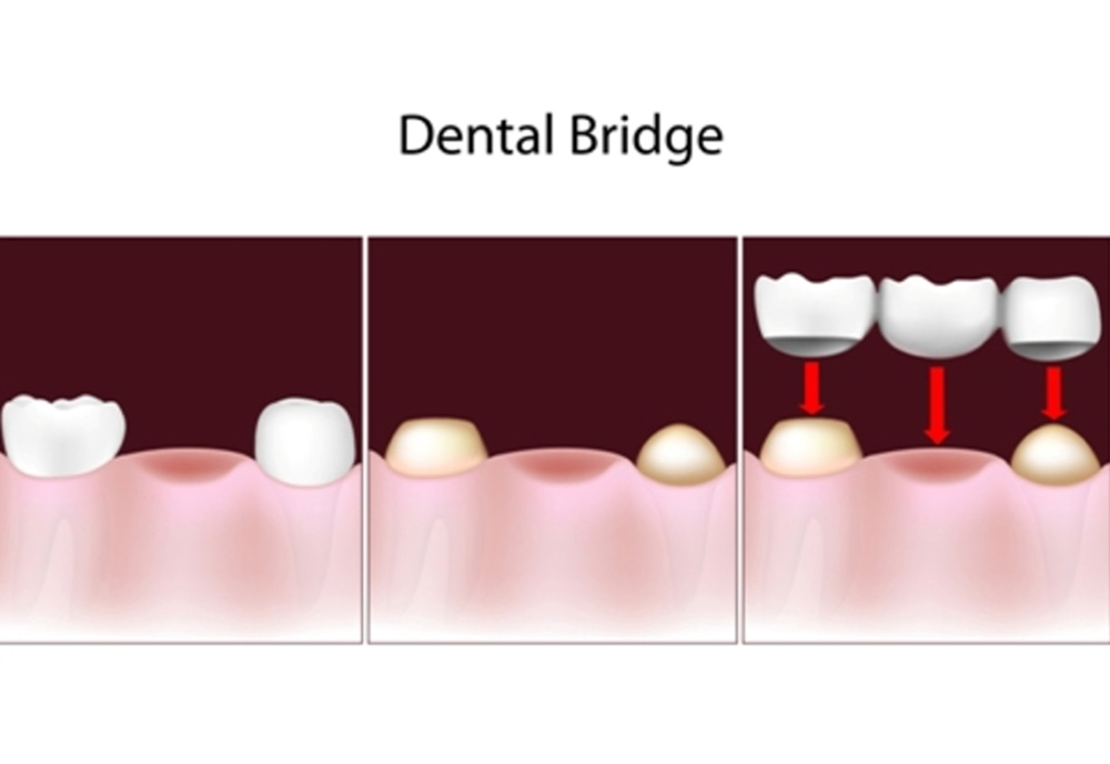 dental bridges in south edmonton