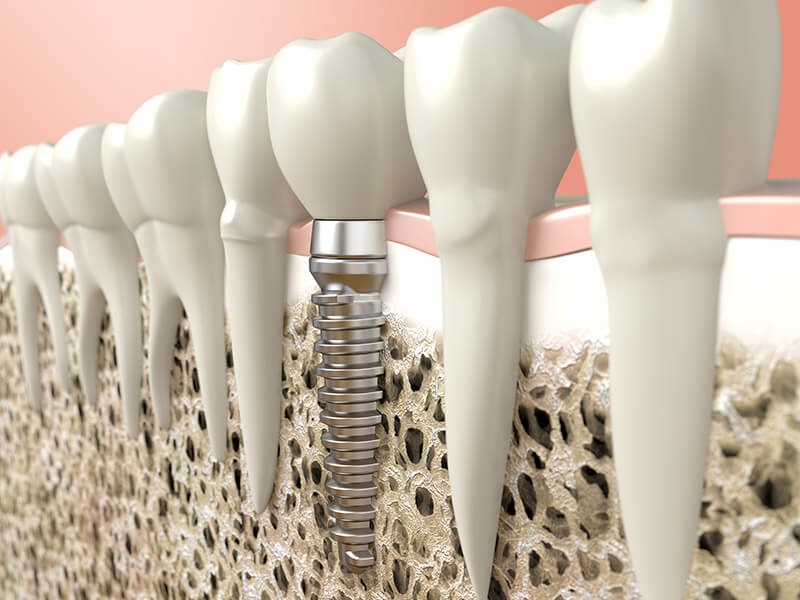 dental implants in south edmonton