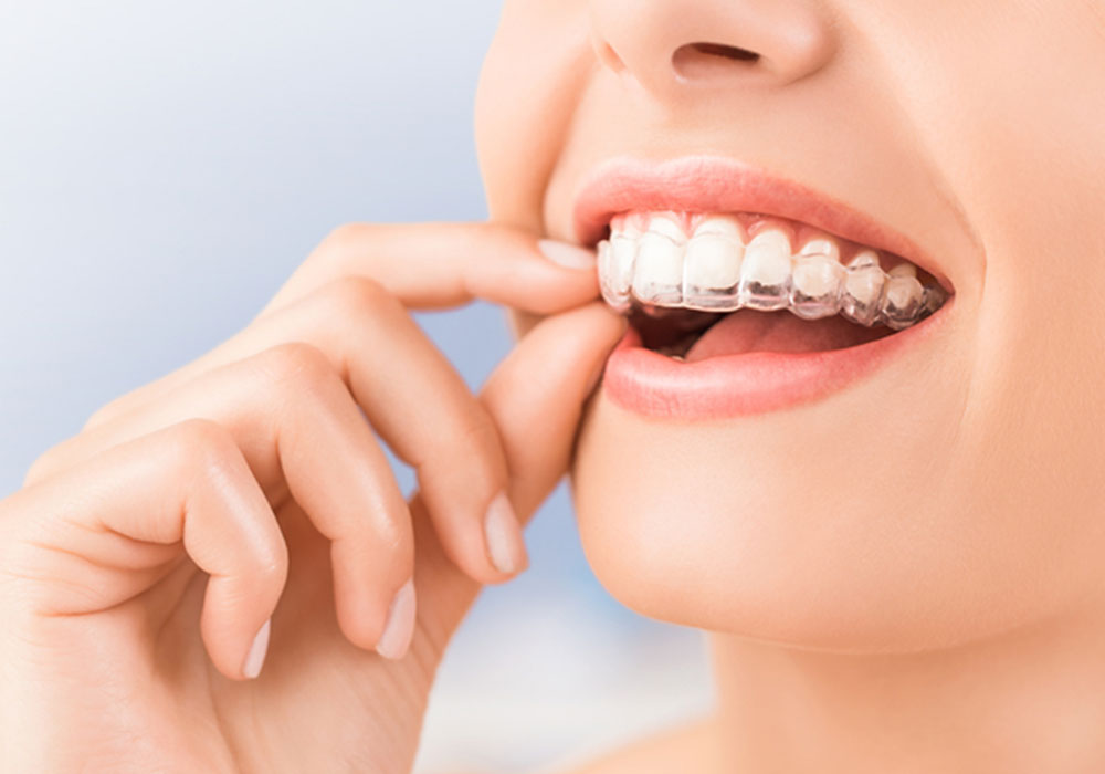 invisalign in south edmonton