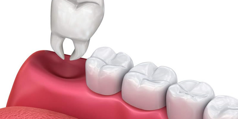 tooth extractions in south edmonton