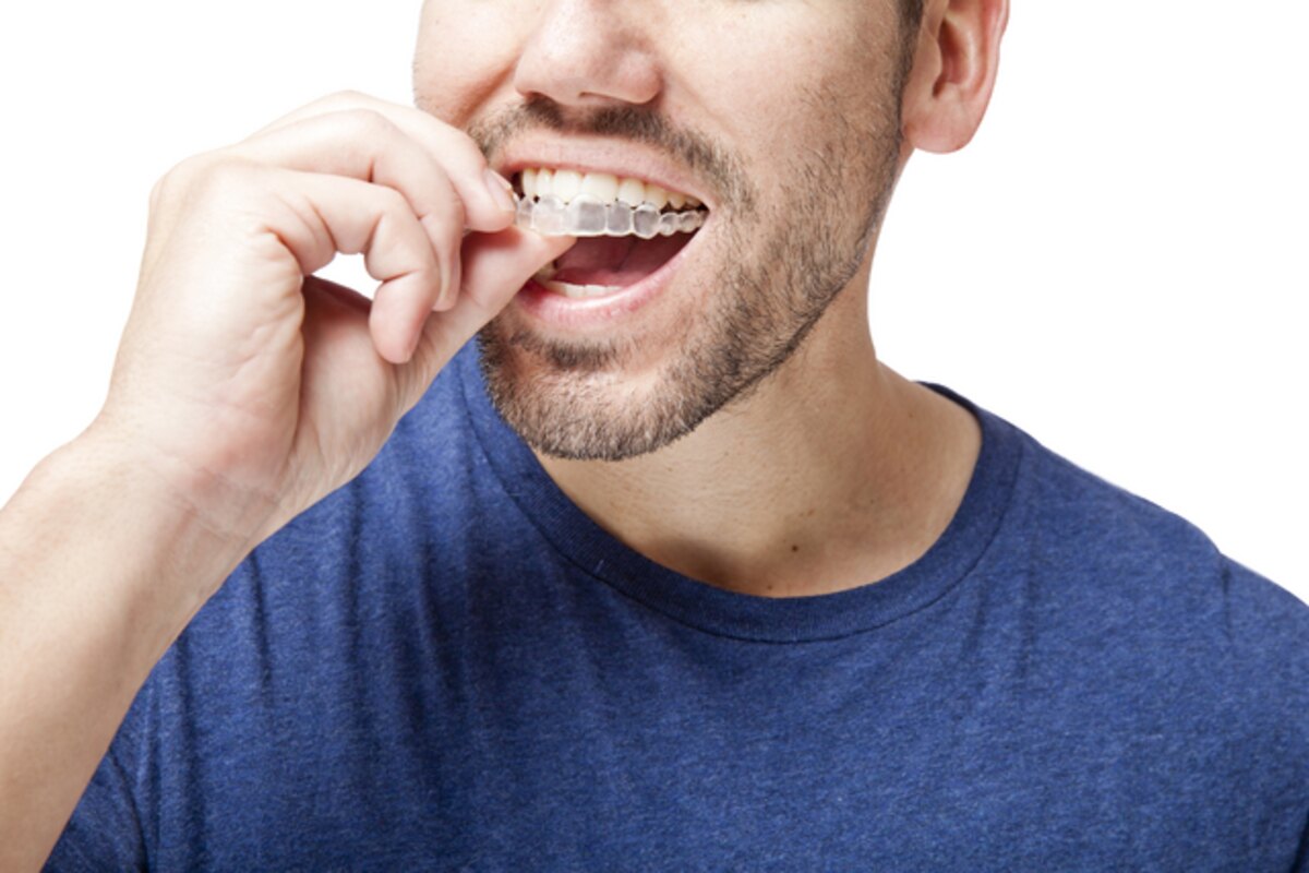 invisalign 101 easy steps to achieving straight teeth