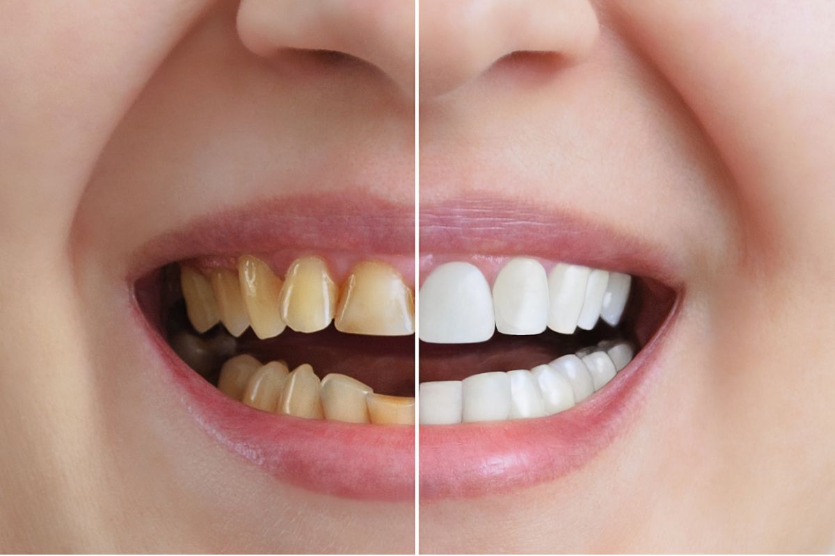 professional teeth whitening: everything you need to know