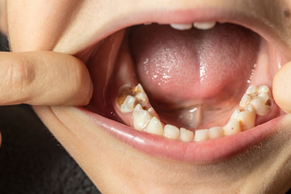 why do fillings lead to tooth decay under the fillings