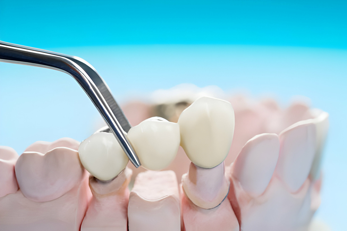 what are the long-term effects of dental bridges on oral health
