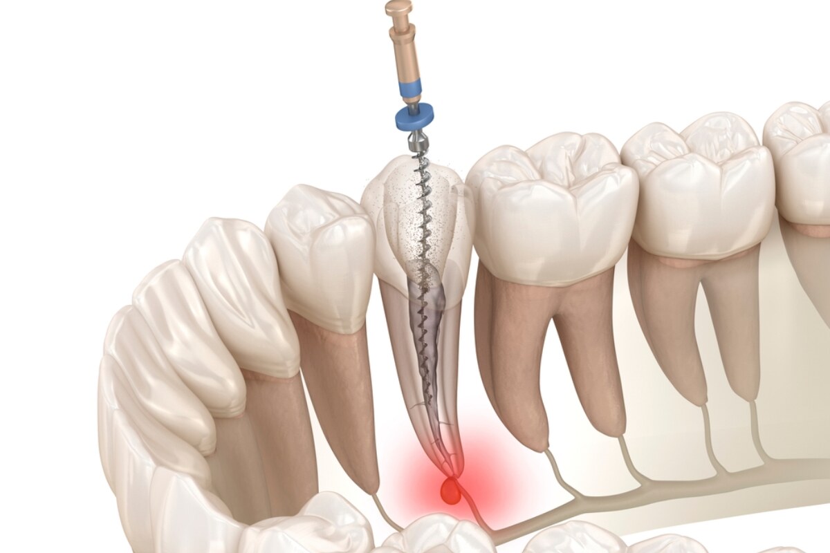 surgical vs non surgical root canal therapy