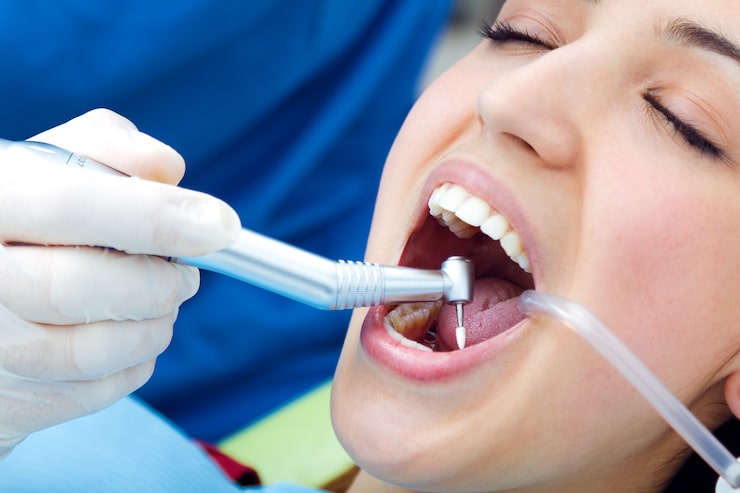 Causes of cavities prevented by dental sealants