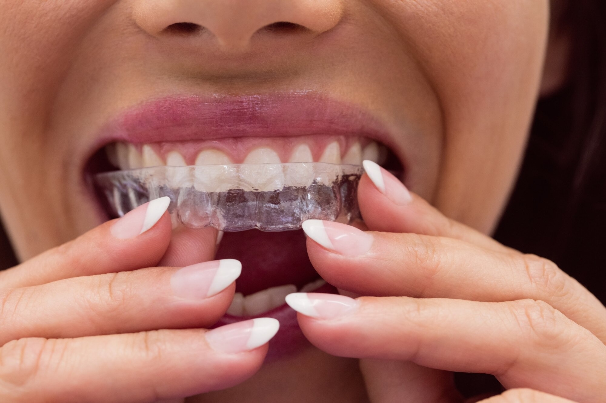 How custom mouthguards prevent sports dental injuries